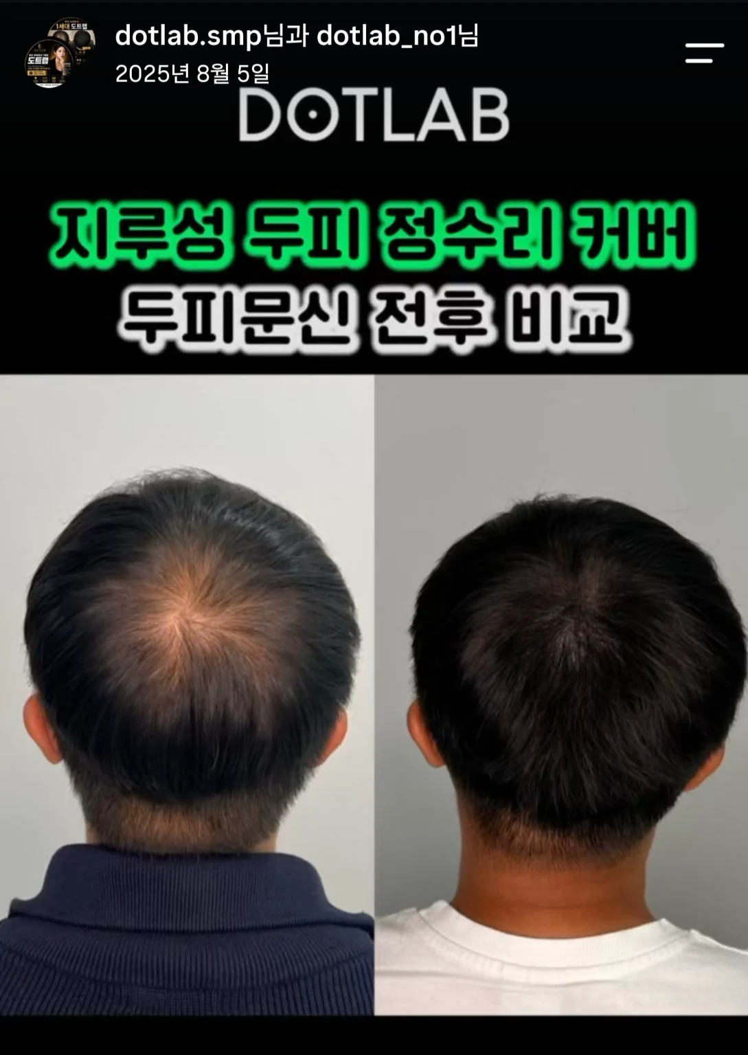 부산 남성 정수리 커버 전후 사례 실제 게시물 이미지