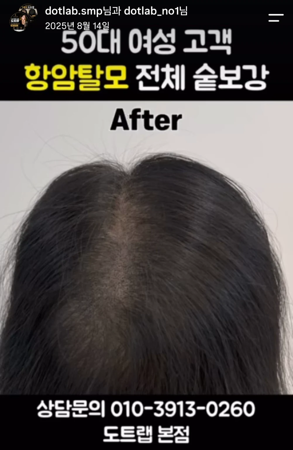 부산 50대 여성 가르마 SMP 숱보강 사례 진행 후