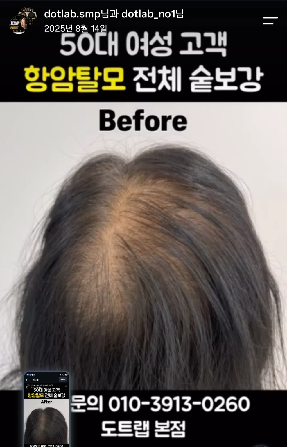 부산 50대 여성 가르마 SMP 숱보강 사례 진행 전