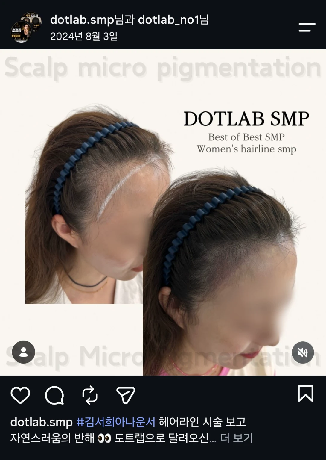 부산 여성 헤어라인 SMP 디자인 사례 실제 게시물 이미지